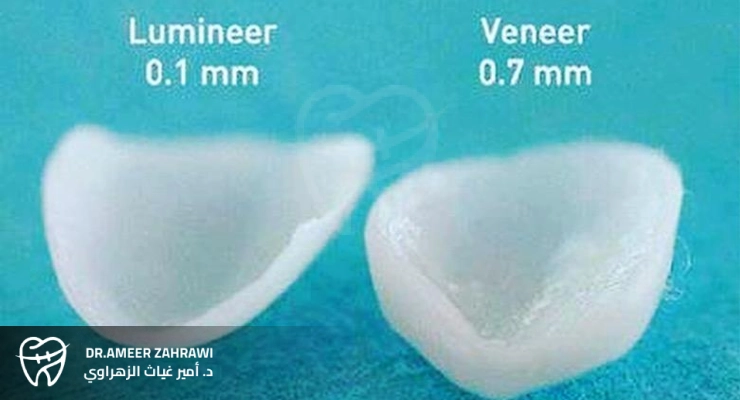 الفرق بين الفينير واللومينير