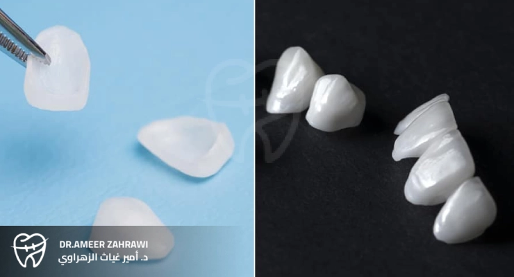 الأعراض الجانبية الفينير واللومينير