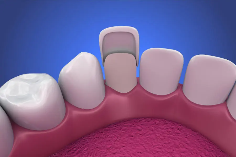 الفرق بين الفينير واللومينير