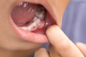 ما هو خراج الاسنان وأعراضه وما هي طرق علاجه