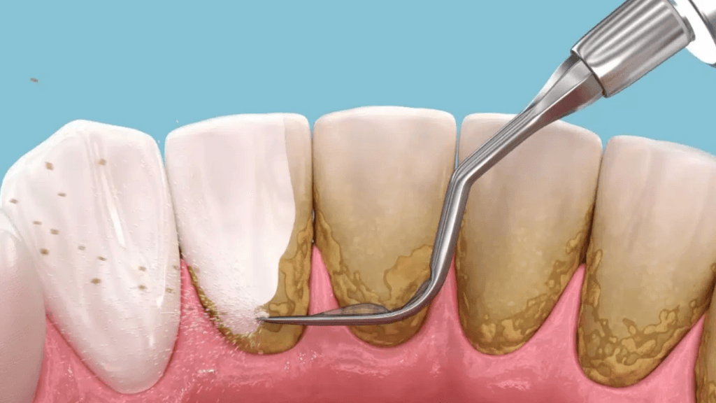 التنظيف العميق للأسنان
