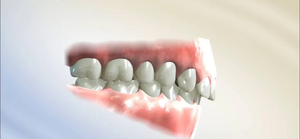 العضة المعكوسة للأسنان و اسبابها و علاجها