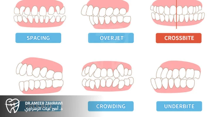 أنواع عضات الأسنان