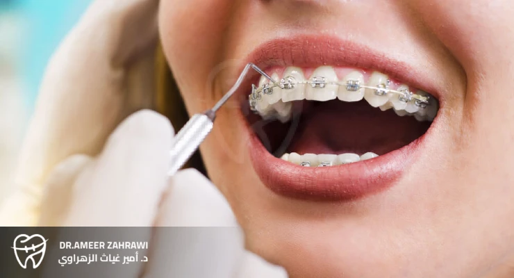 تقويم الأسنان