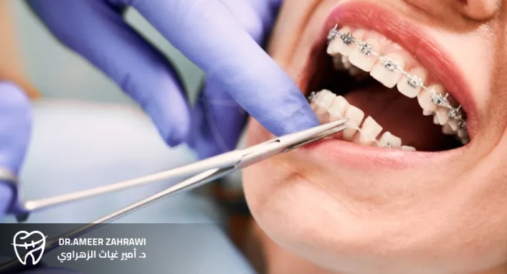 مراحل تركيب تقويم الأسنان 