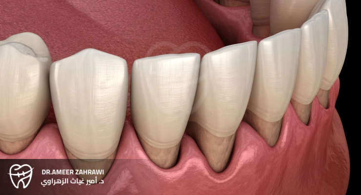 عملية استئصال اللثة