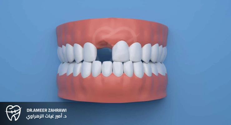 استبدال الأسنان المفقودة