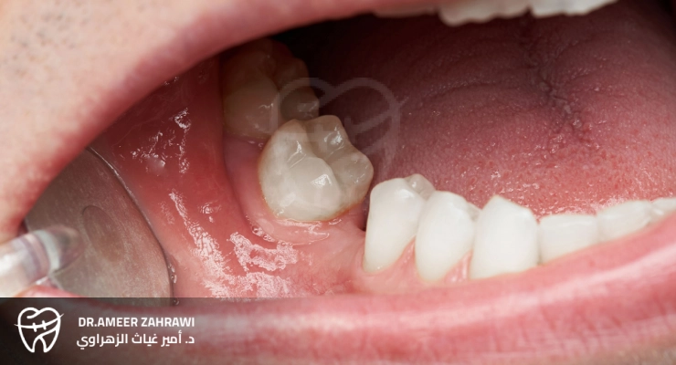 أعراض بداية استبدل الأسنان
