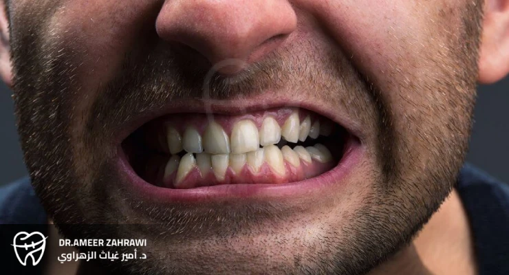 أعراض طحن الأسنان