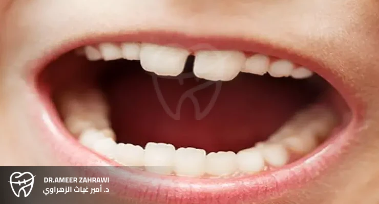 علاج الأسنان اللبنية