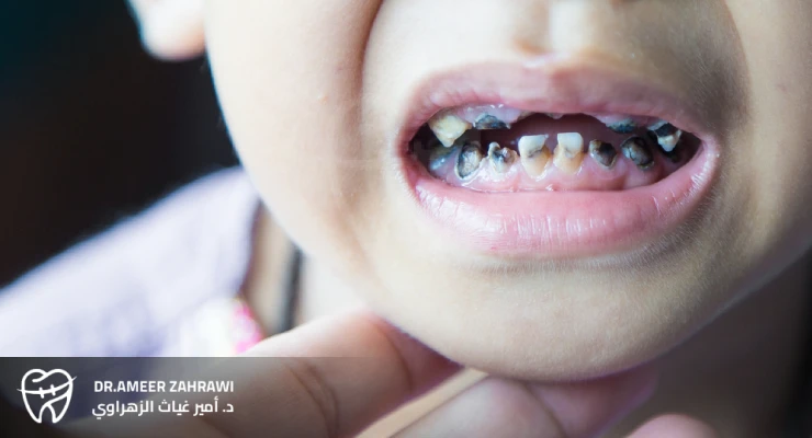 علاج تسوس الأسنان للأطفال
