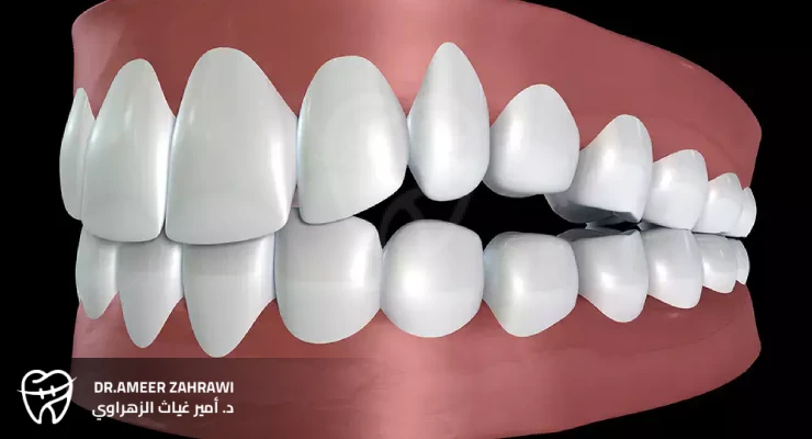 العضة المفتوحة