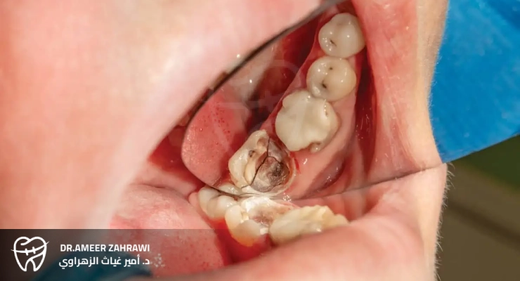 أعراض تصدع وتشقق الأسنان