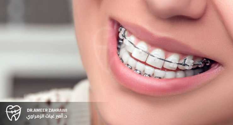 لمن يناسب تقويم الديمون؟