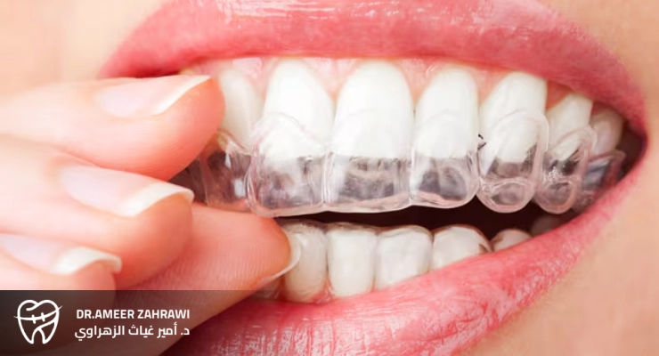 قوالب تبييض الأسنان