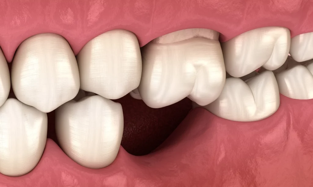 تساقط الأسنان: الأسباب، الأعراض والعلاج الفعّال