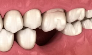 تساقط الأسنان: الأسباب، الأعراض والعلاج الفعّال