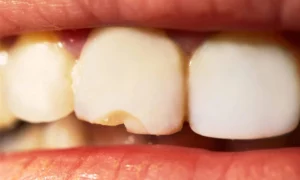 تصدع وتشقق الأسنان