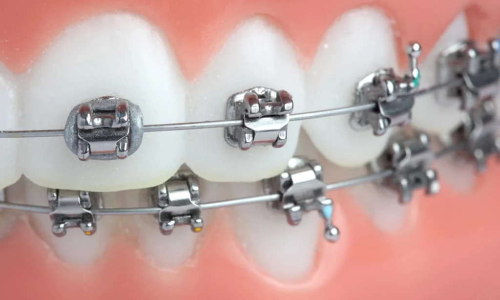 تقويم الديمون للأسنان: مميزاته، مراحله والعناية أثناء التركيب