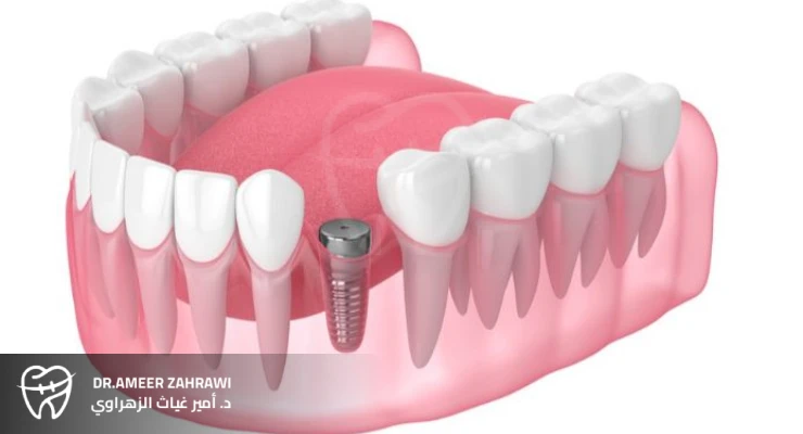 زراعة التيتانيوم