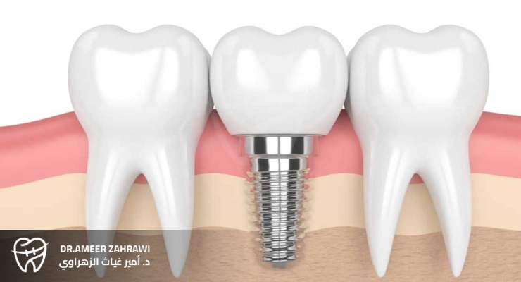 زراعة الزركونيا
