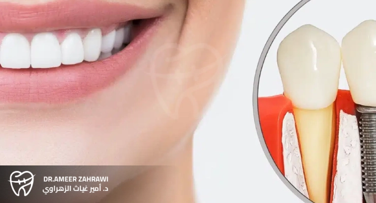 ما العوامل التي تؤثر على تكلفة زراعة الأسنان؟