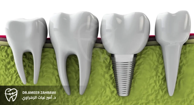 كيف تختار زراعة الأسنان المناسبة لحالتك؟