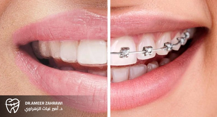 الفرق بين تقويم الأسنان الشفاف والمعدني
