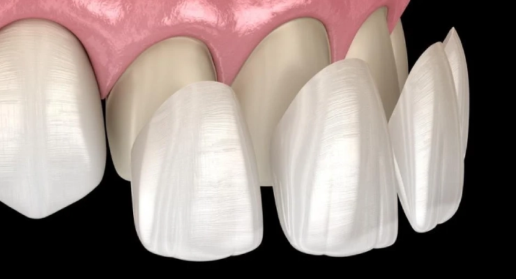 لون الفينير المثالي