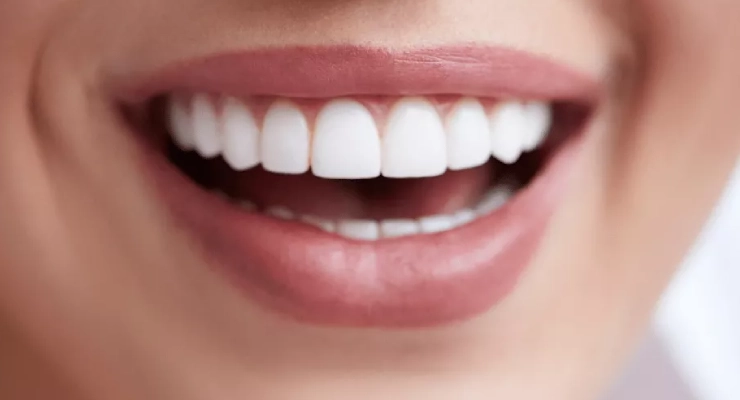 كيف يؤثر لون الفينير على شكل ابتسامتك؟