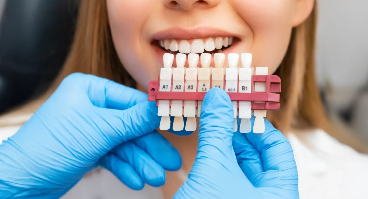 أخطاء شائعة عند اختيار لون الفينير وكيفية تجنبها