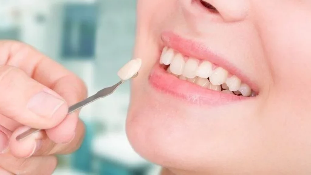 الفرق بين الفينير التقليدي والمركب