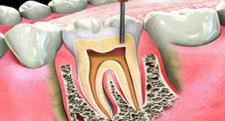 التهاب عصب الأسنان المزمن