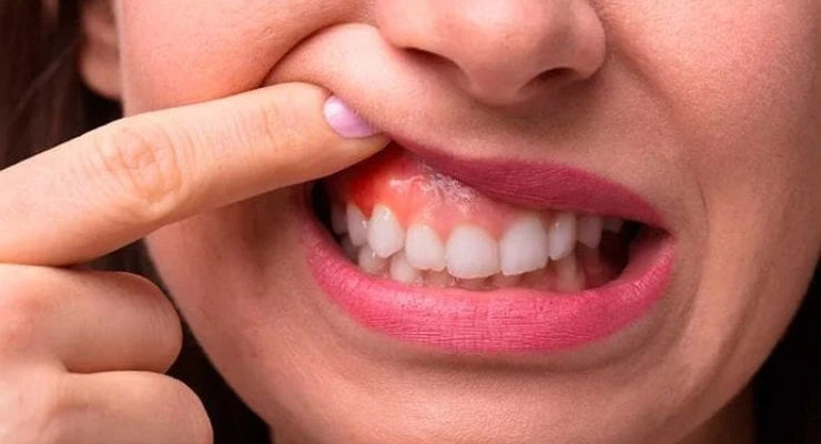 العلاقة بين التغذية المتوازنة والوقاية من أمراض اللثة