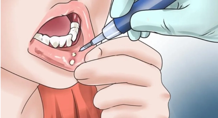 تقرحات الفم