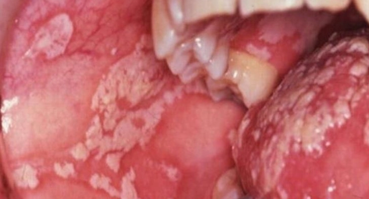 العوامل التي تزيد من احتمالية ظهورها