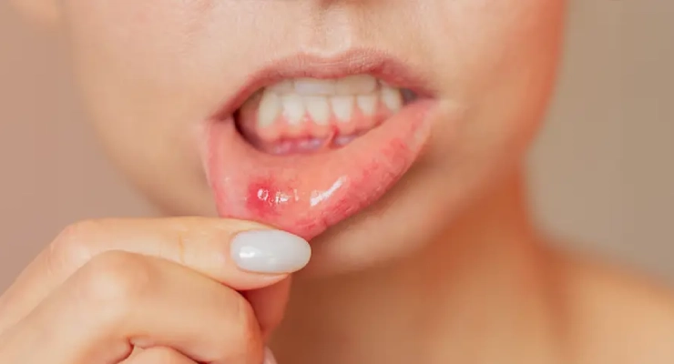 طرق علاج تقرحات الفم 