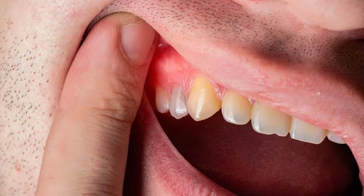 خراج الأسنان