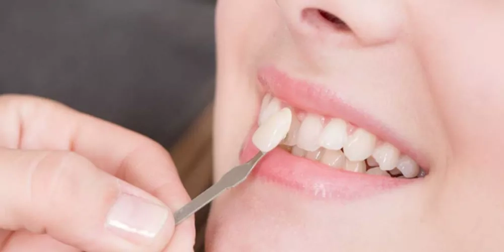 الفرق بين الفينير التقليدي والمركب