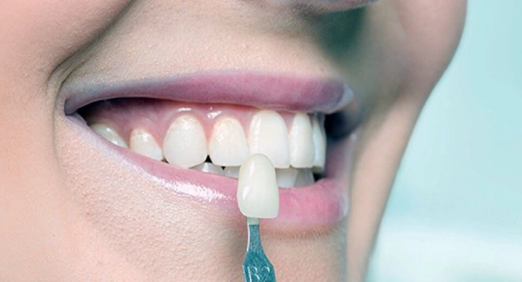 العدسات التجميلية والفينير التقليدي