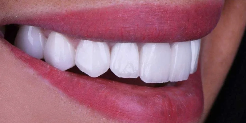 العادات اليومية التي تؤثر على متانة الفينير