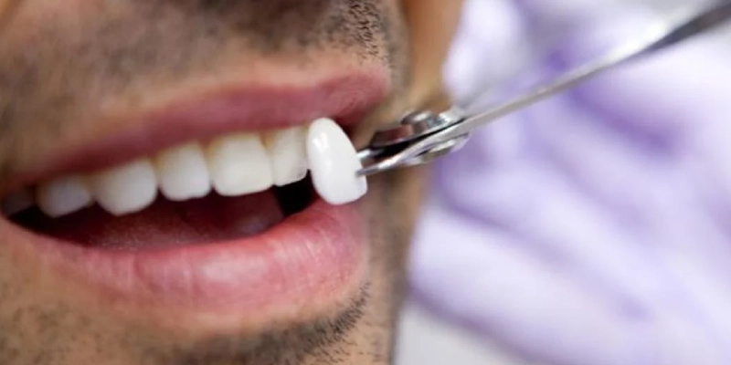 الفرق بين العناية بالفينير والعناية بالأسنان الطبيعية