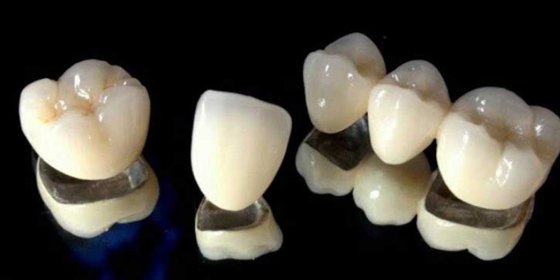 الفرق في الأسعار بين التيجان المعدنية وتيجان الزيركون
