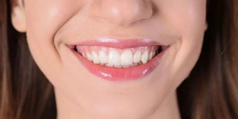 القشور التجميلية (الفينير) كحل لتحسين الابتسامة