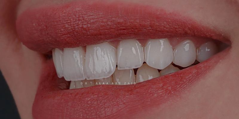 قشور الإيماكس