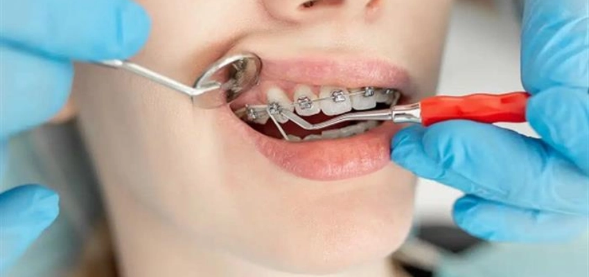 الحفاظ على نتائج تقويم الأسنان