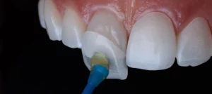 قشور الإيماكس