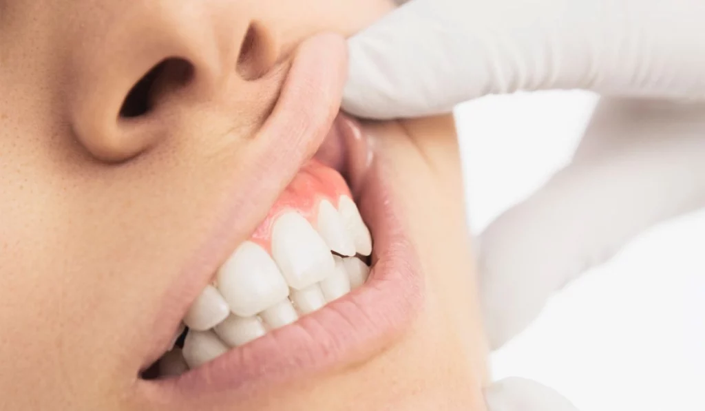 حساسية الأسنان