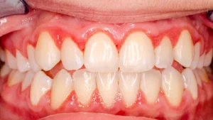 التهاب اللثة المزمن