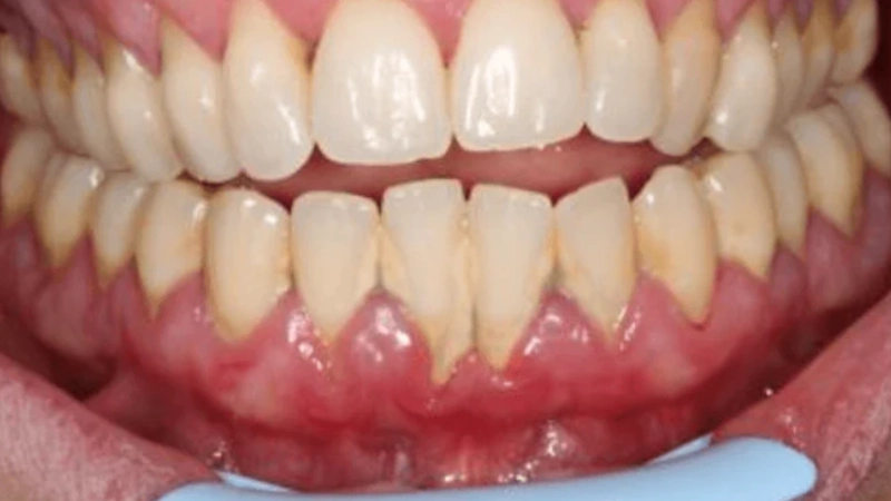 علاج التهاب اللثة بالليزر في عيادة الأسنان